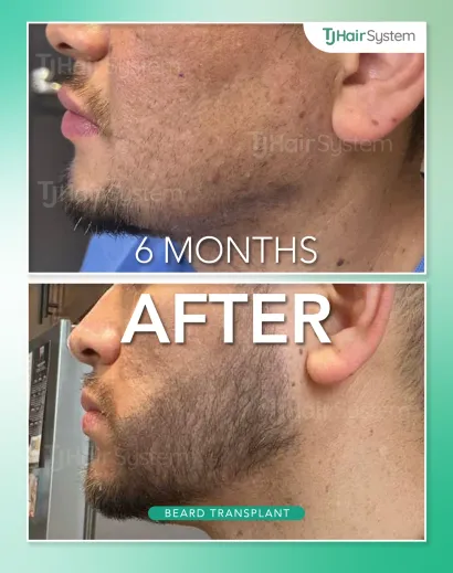 Before and after: Jawline & chin, Dark hair, 6 months