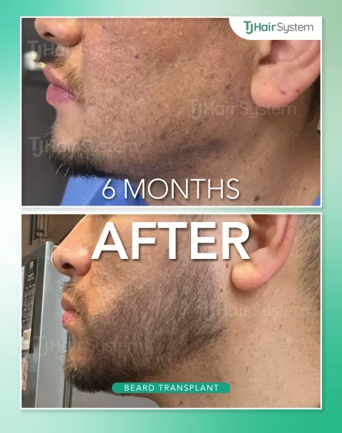 Before and after: Jawline & chin, Dark hair, 6 months
