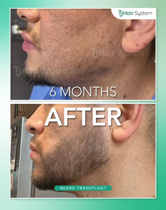 Before and after: Jawline & chin, Dark hair, 6 months
