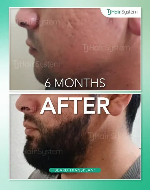 Before and after: Full beard, Dark, thick hair, 6 months