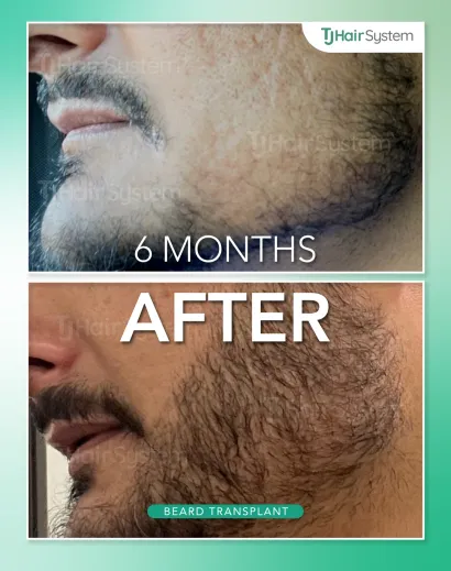 Before and after: Cheeks & jaw, Dark hair, 6 months