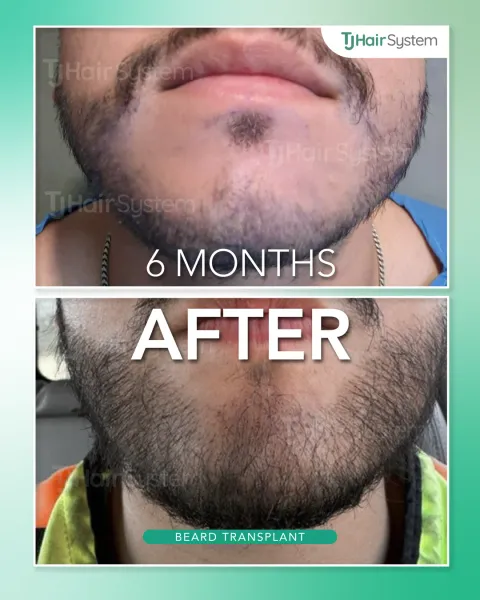 Before and after: Chin & lower beard, Dark, coarse hair, 6 months