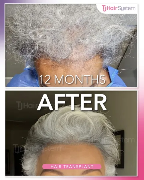 Before and after: Overall density, Coarse, gray hair, 12 months
