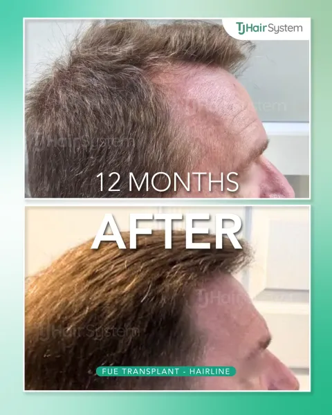 Before and after: Temples & side profile, Wavy, brown hair, 12 months