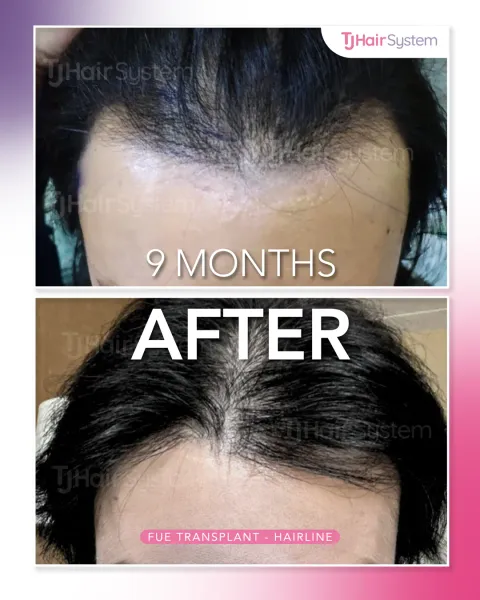 Before and after: Hairline & part line, Straight, black hair, 9 months