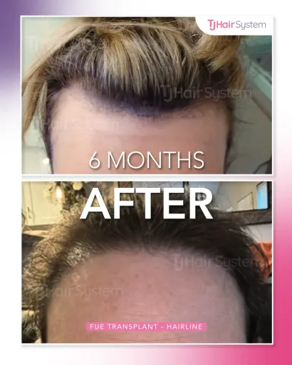Before and after: Receding frontal edge, Straight, blond hair, 6 months