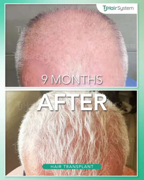 Before and after: Crown & vertex, Fine, white hair, 9 months