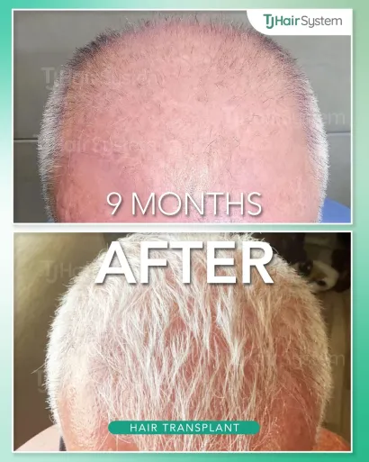 Before and after: Crown & vertex, Fine, white hair, 9 months