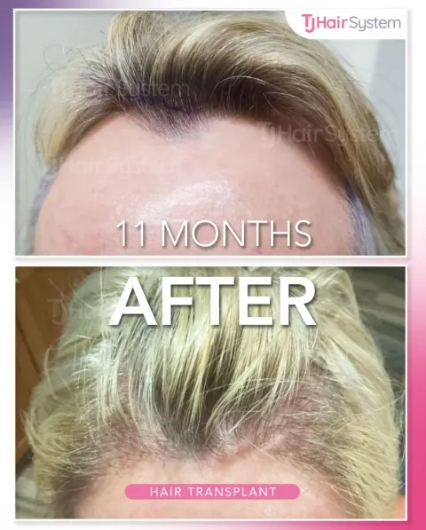 Before and after: Hairline & temples, Fine, blond hair, 11 months