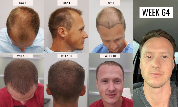 Hair Transplant Facts and Recovery Everything one should know before  trying it  Dr Soniya Hair Transplant